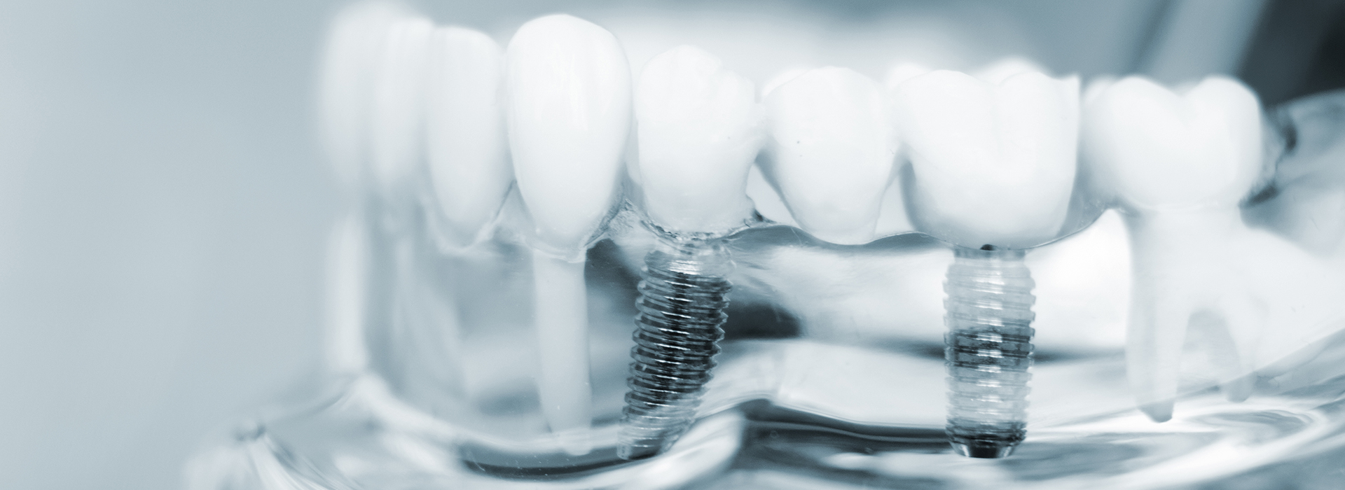 Carolina Prosthodontics   Implant Dentistry