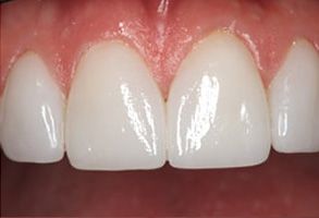 Carolina Prosthodontics   Implant Dentistry | Implant Dentistry, Replacing Multiple Teeth and CAD CAM