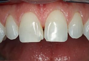 Carolina Prosthodontics   Implant Dentistry | Single Tooth Implant, Full mouth reconstruction and Dental Bridges